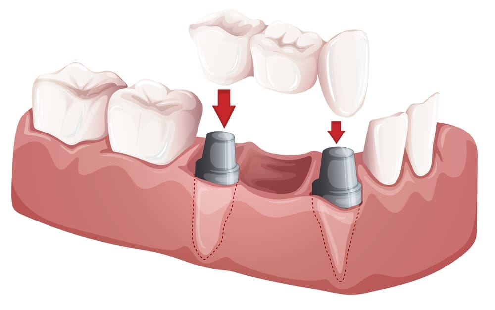 Eugene Dental Bridges Near me