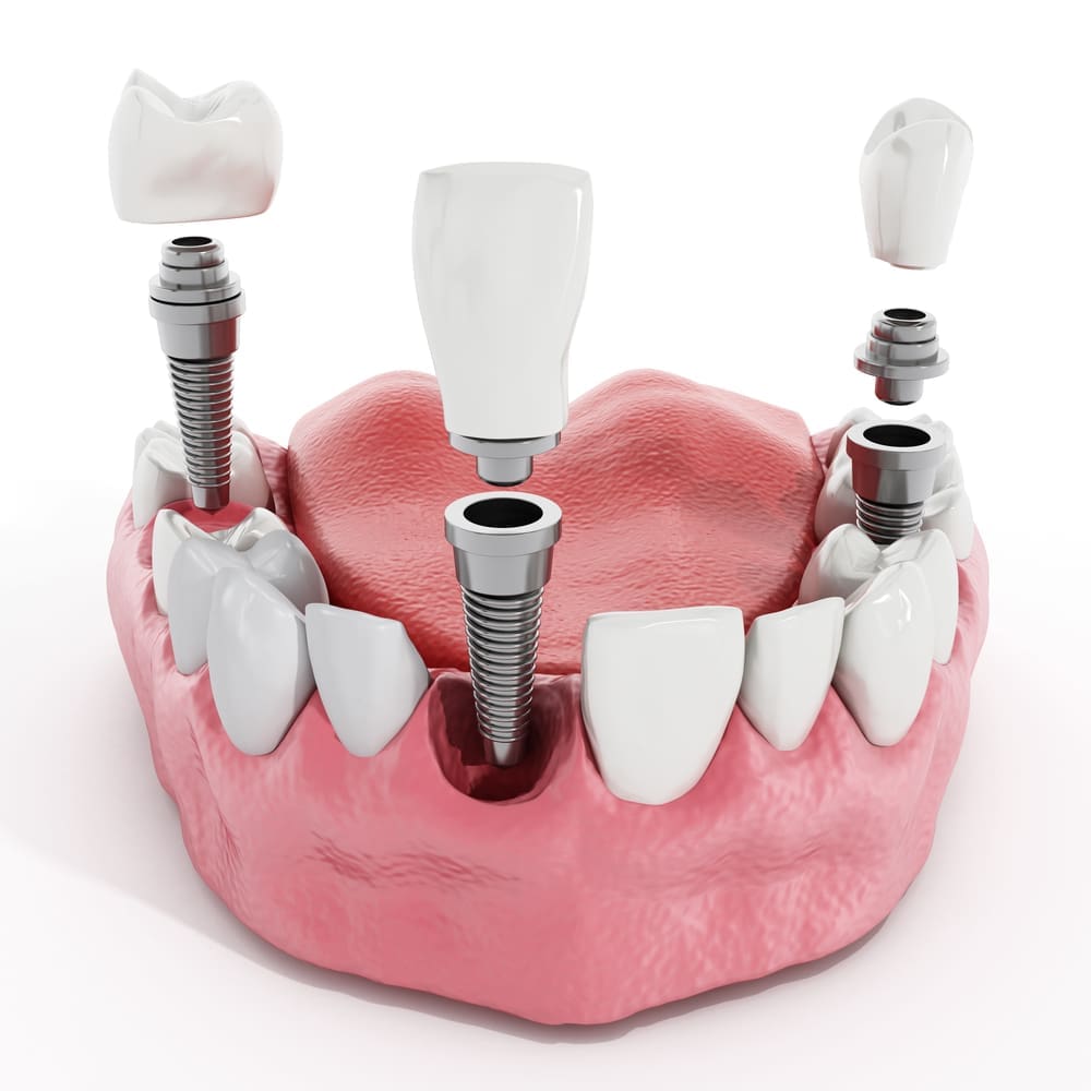 Eugene Dental Implants, Eugene Dental Implants affordable dental implants, dental implants near me, best dental implants, with Wellness Centered Dentistry