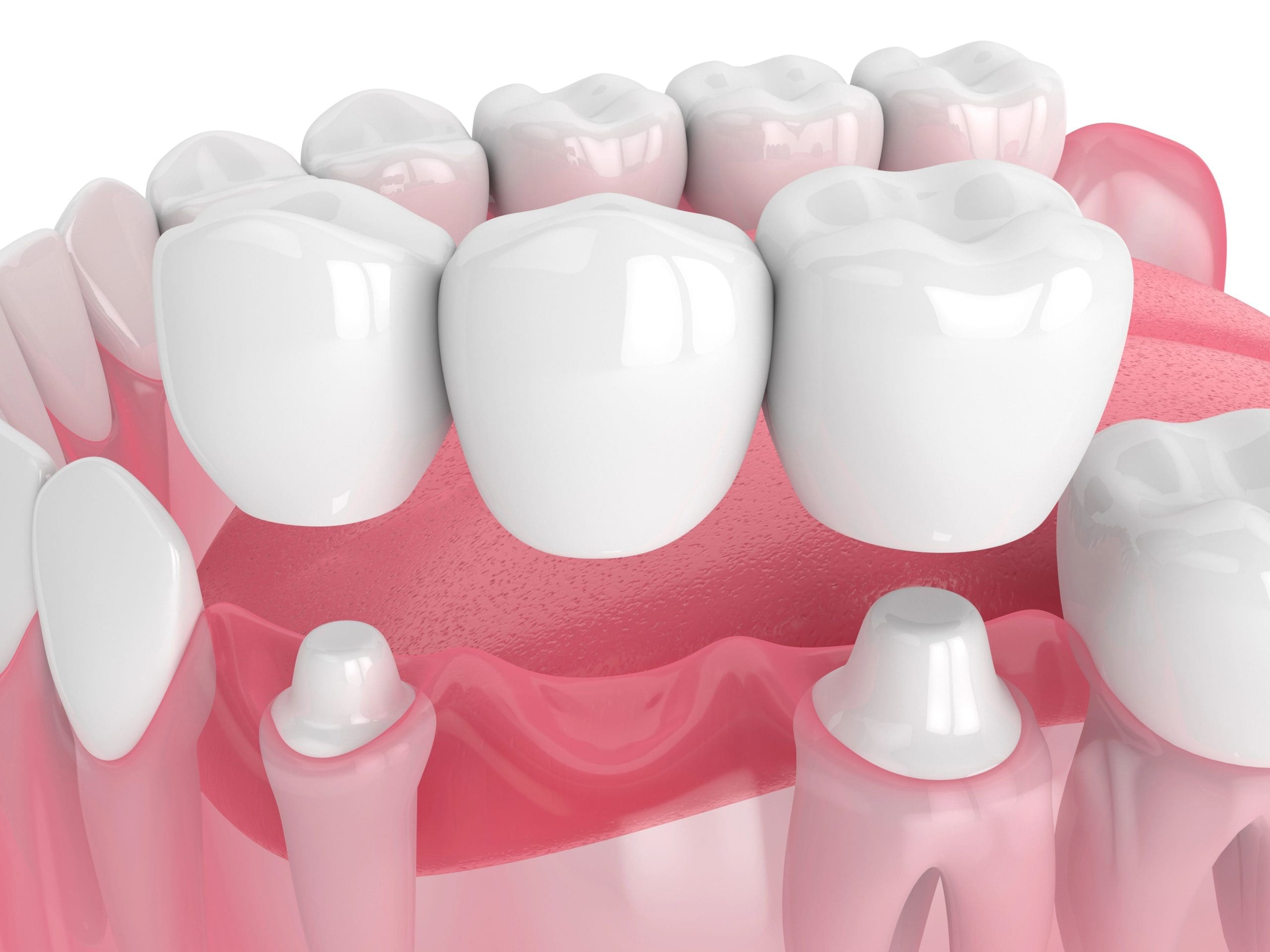 Dental Bridge Cost: Key Factors and Tips for Affordable Options