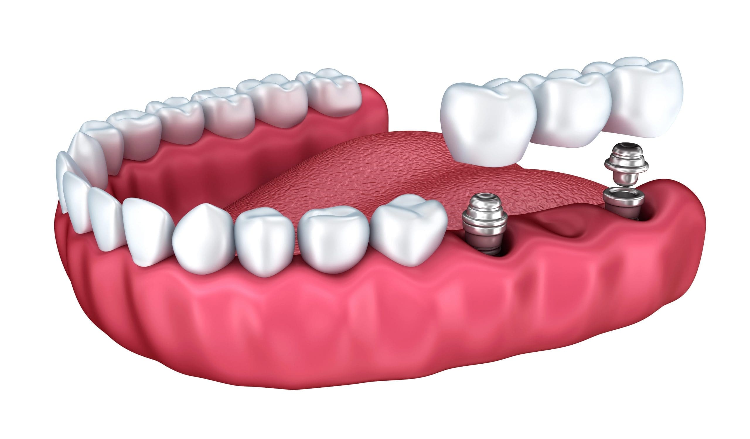 Dental Bridge vs Implant: How to Choose the Best Option